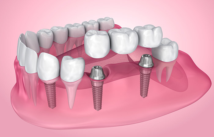 dental implants in red deer