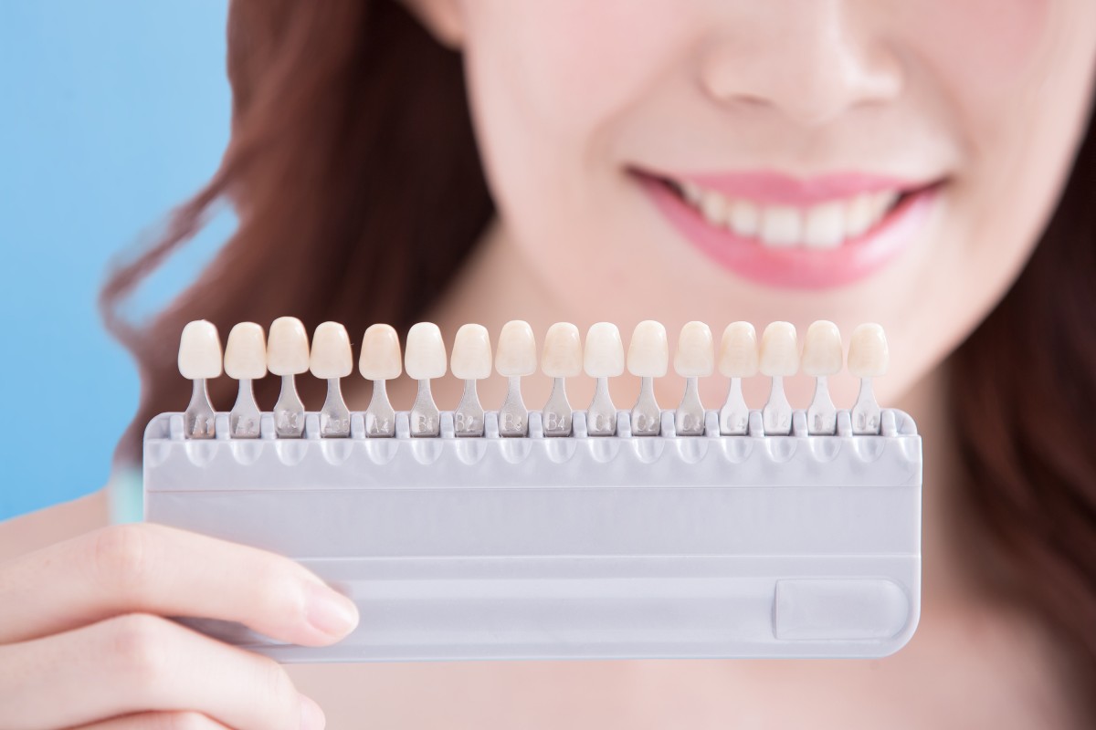 5 facts to know while choosing veneers