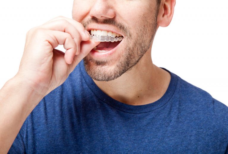 What Happens If You Don't Wear Your Invisalign Trays For A Few Days?