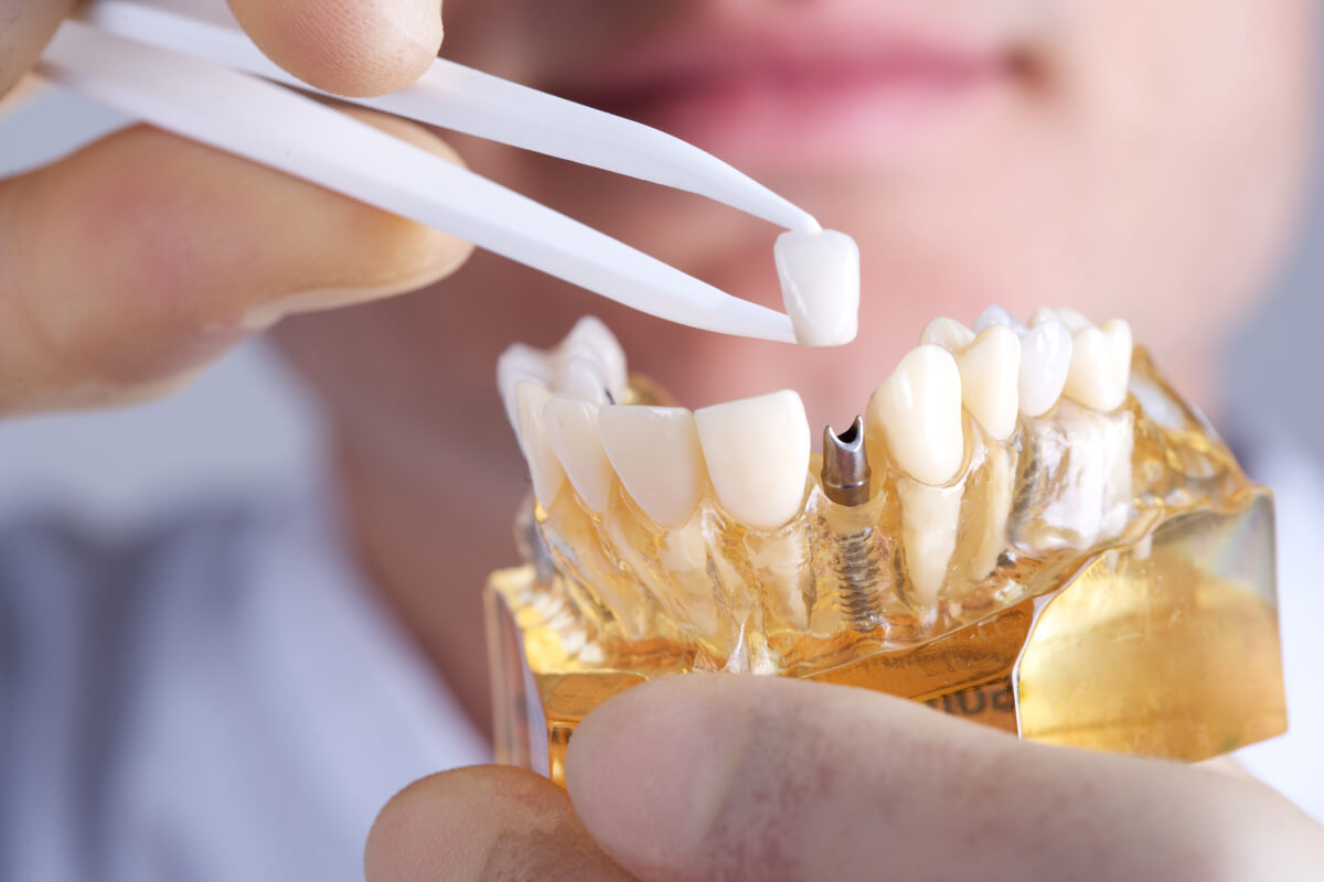 3 things you must know about dental implants