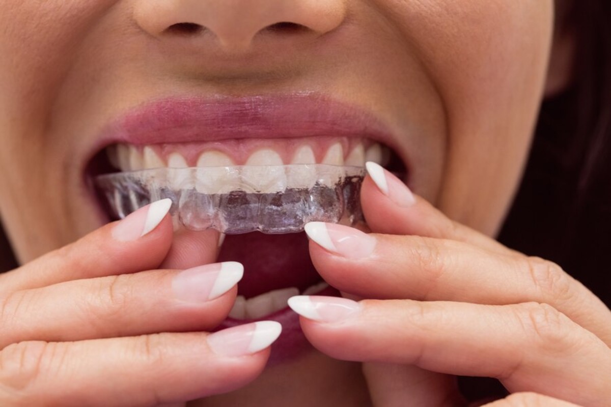 navigating the choice between invisalign and traditional braces