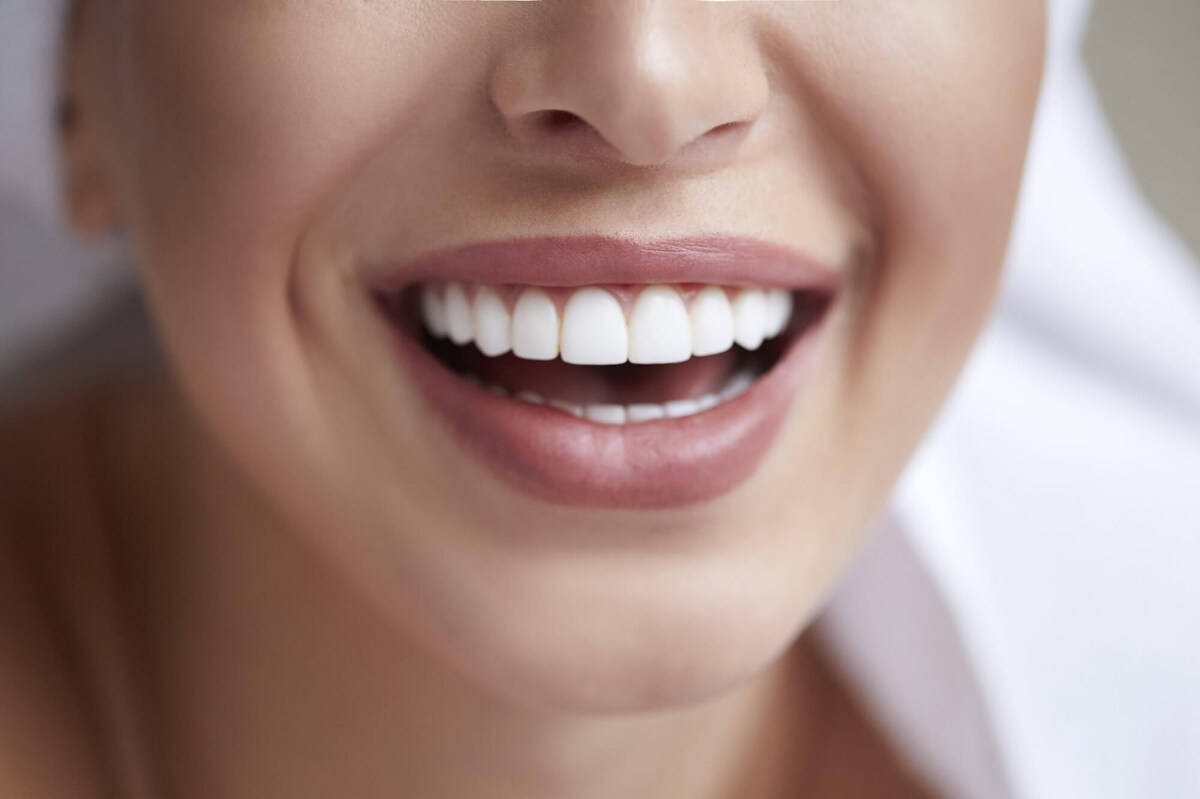 reasons to consider professional teeth whitening