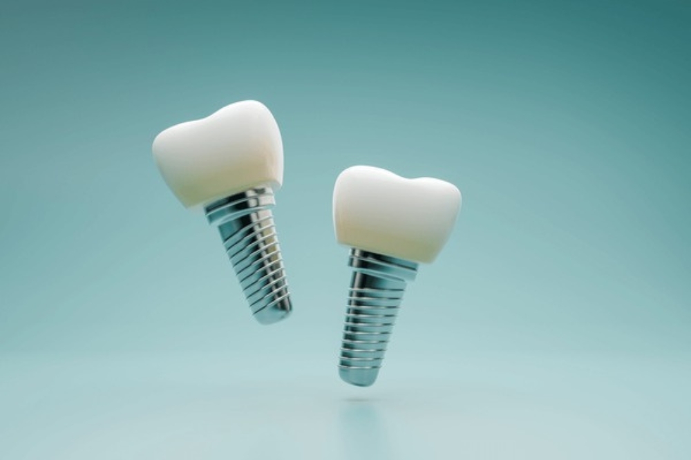 How Long Do Dental Implants Last With Proper Care?