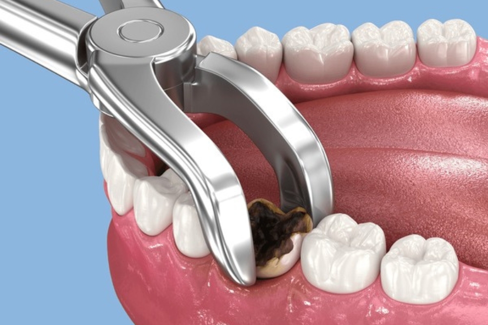 Does a Tooth Extraction Hurt? What Patients Usually Feel