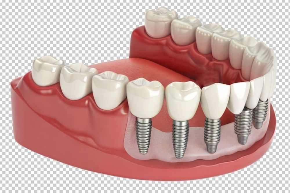 Dental Implants a One-time Investment