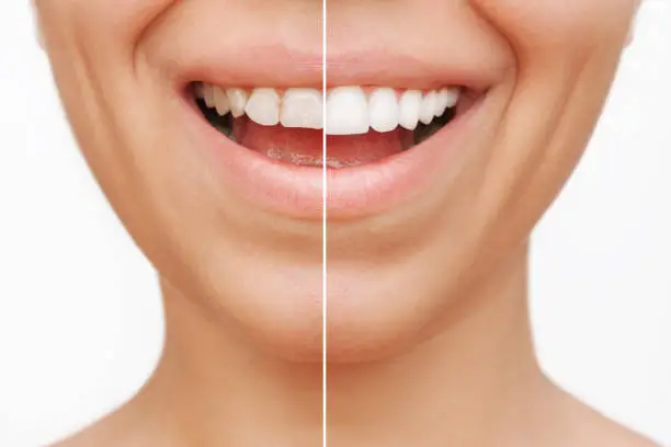 Dentist discussing porcelain veneer options with a patient during a consultation